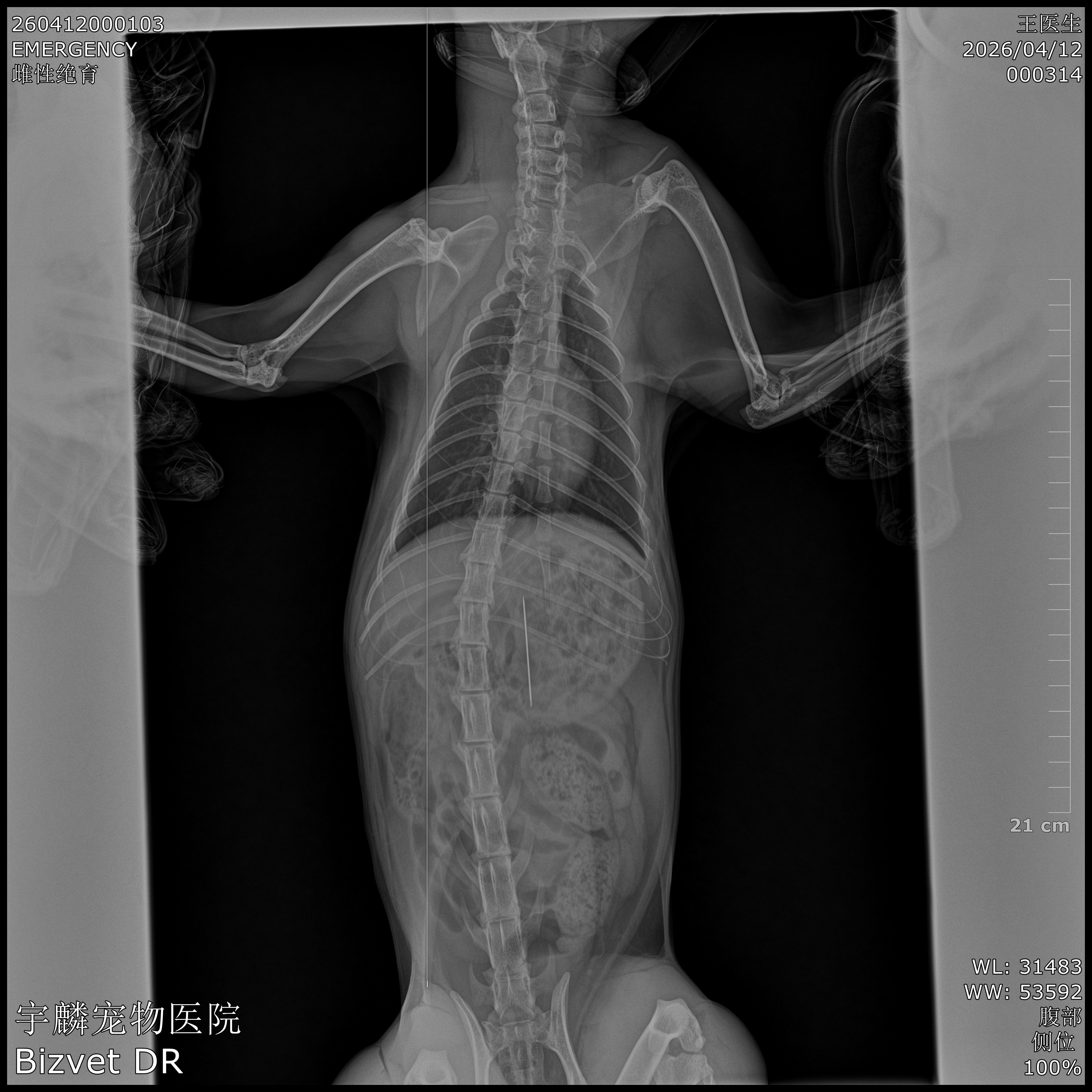 凌晨1点的生死营救：一枚钢针的“食道逆行”奇迹